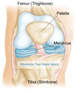 Meniscus Tear Knee Injury, TPL Orthopedics and Sports Medicine