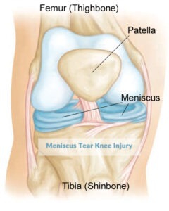 Meniscus Tear Knee Injury, T&amp;P Orthopedics and Sports Medicine
