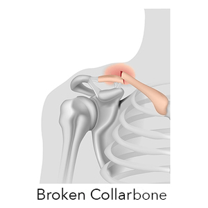 Clavicle Fracture (Broken Collarbone) Treatment, T&amp;P Orthopedics and Sports Medicine