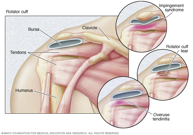 Rotator Cuff Strain / Tear, T&amp;P Orthopedics and Sports Medicine