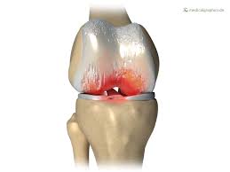 Degeneration of Joint Cartilage Treatment, TPL Orthopedics and Sports Medicine