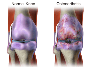 What is osteoarthritis?, T&amp;P Orthopedics and Sports Medicine