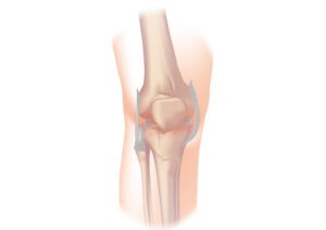 What are the early signs of osteoarthritis?, T&amp;P Orthopedics and Sports Medicine