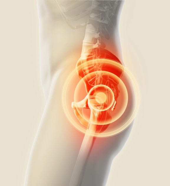 How Long Does It Take To Recover From Total Hip Surgery?, T&amp;P Orthopedics and Sports Medicine