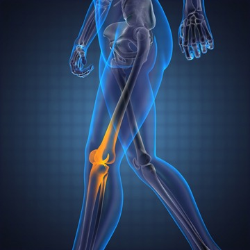 How Long Does It Take to Recover From Total Knee Surgery?, TPL Orthopedics and Sports Medicine