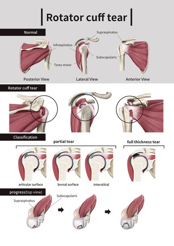 Arthroscopic Rotator Cuff Repair, TPL Orthopedics and Sports Medicine