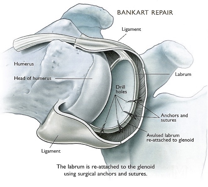 Bankart Repair, TPL Orthopedics and Sports Medicine