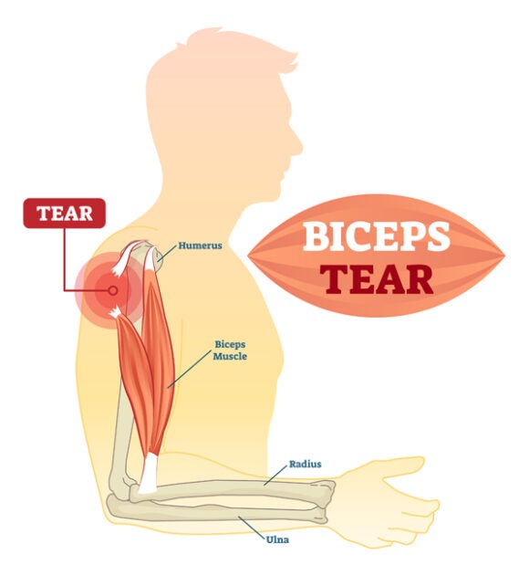 Bicep Tendon Tear, TPL Orthopedics and Sports Medicine