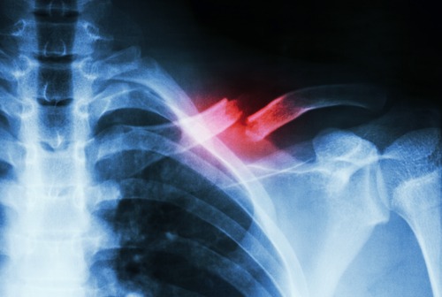 Broken Collarbone, TPL Orthopedics and Sports Medicine