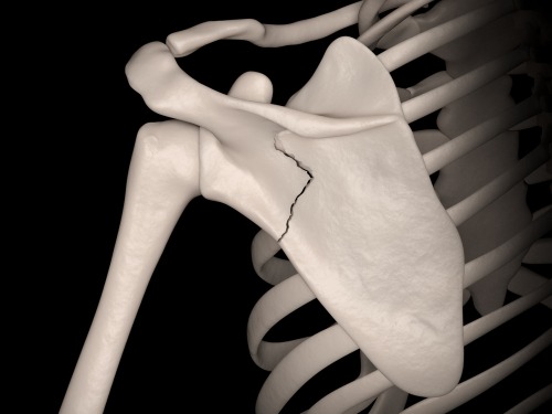 Fractures of The Shoulder Blade (SCAPULA), TPL Orthopedics and Sports Medicine