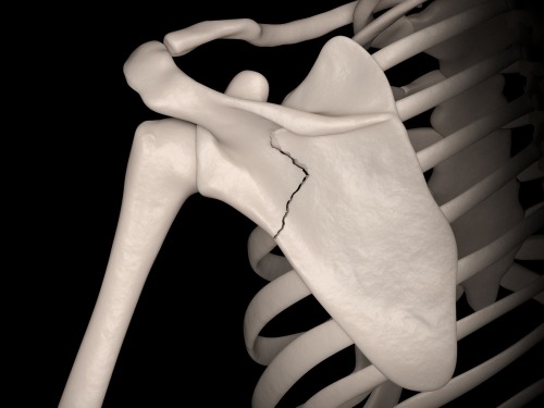 Fractures of The Shoulder Blade (SCAPULA), T&amp;P Orthopedics and Sports Medicine