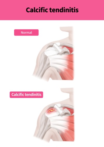 Calcific Tendinitis of The Shoulder, TPL Orthopedics and Sports Medicine