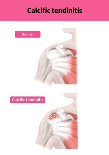 Calcific Tendinitis of The Shoulder, T&amp;P Orthopedics and Sports Medicine