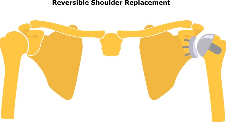 Reverse Total Shoulder Replacement, TPL Orthopedics and Sports Medicine