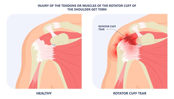 Shoulder Joint Tear (Glenoid Labrum Tear), T&amp;P Orthopedics and Sports Medicine