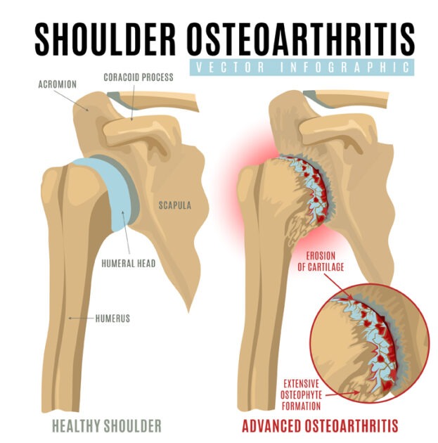 Shoulder Arthritis, TPL Orthopedics and Sports Medicine