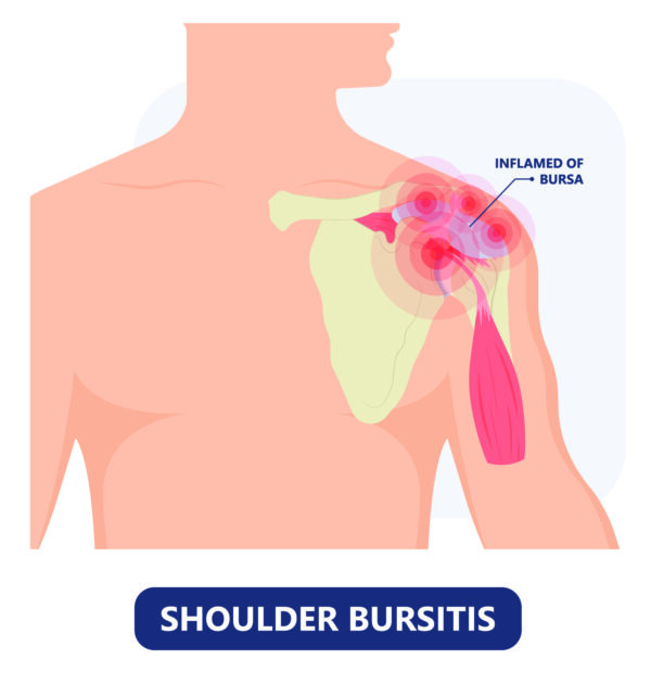 Bursitis of The Shoulder, TPL Orthopedics and Sports Medicine