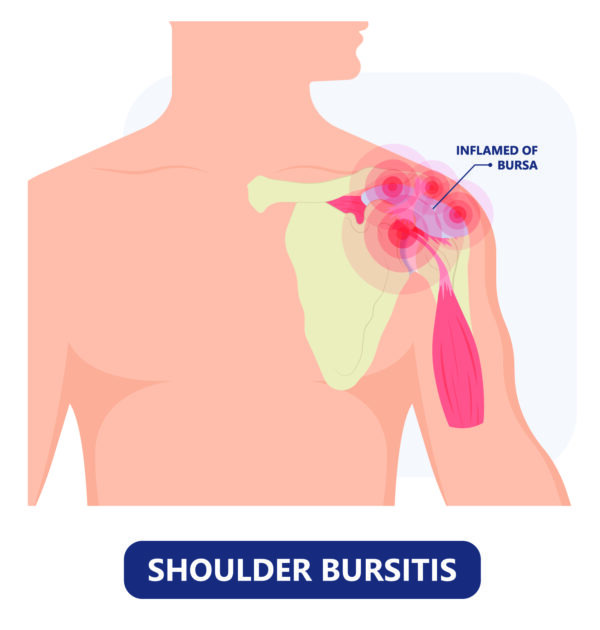 Bursitis of The Shoulder, T&amp;P Orthopedics and Sports Medicine