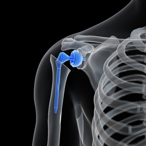 Shoulder Replacement, TPL Orthopedics and Sports Medicine