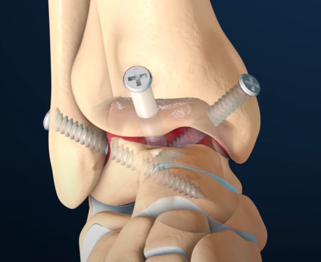Joint Fusion Surgery, T&amp;P Orthopedics and Sports Medicine