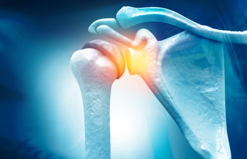 Shoulder Impingement, TPL Orthopedics and Sports Medicine