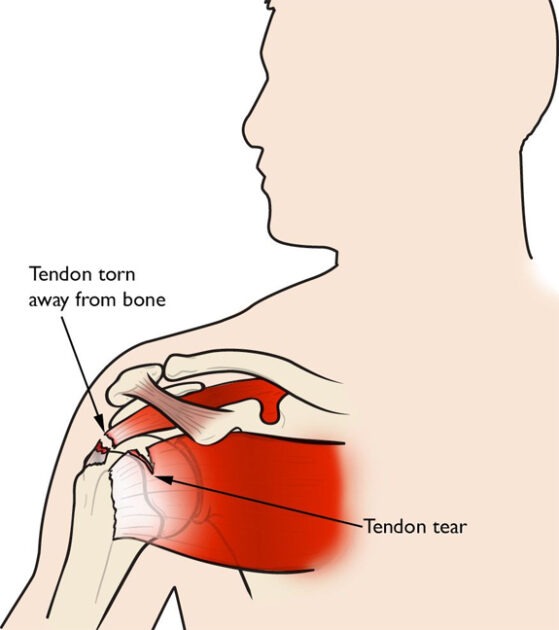 Tendon Tears Of The Shoulder, TPL Orthopedics and Sports Medicine